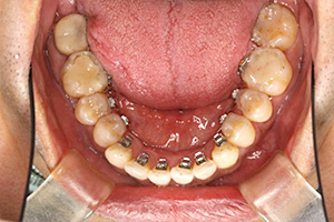 歯周病治療の症例04 矯正中
