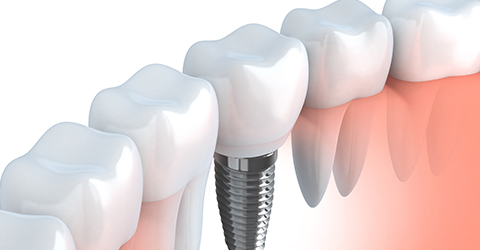 インプラントによる治療について